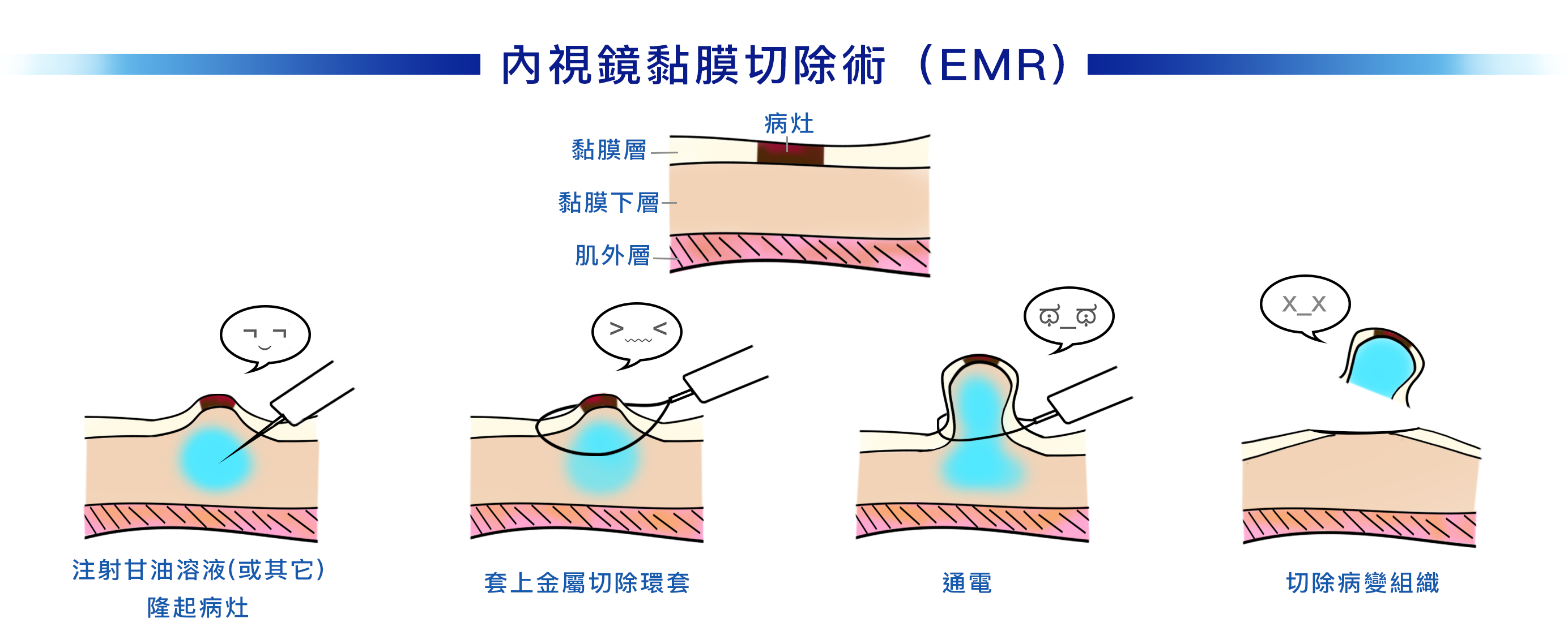 括約筋切開術の副作用と潜在的なリスク